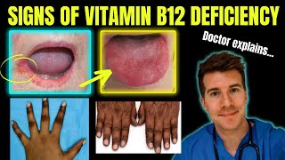 Doctor explains clinical signs of Vitamin B12 (cobalamin) deficiency | Glossitis, mouth ulcers etc. screenshot 1
