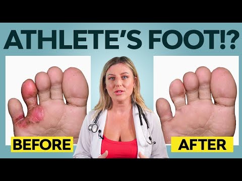 Video: 6 måder at slippe af med fodsvamp