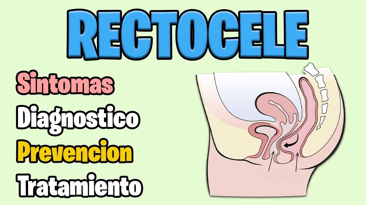 RECTOCELE: Causas, SINTOMAS, DIAGNOSTICO Y TRATAMIENTO - YouTube