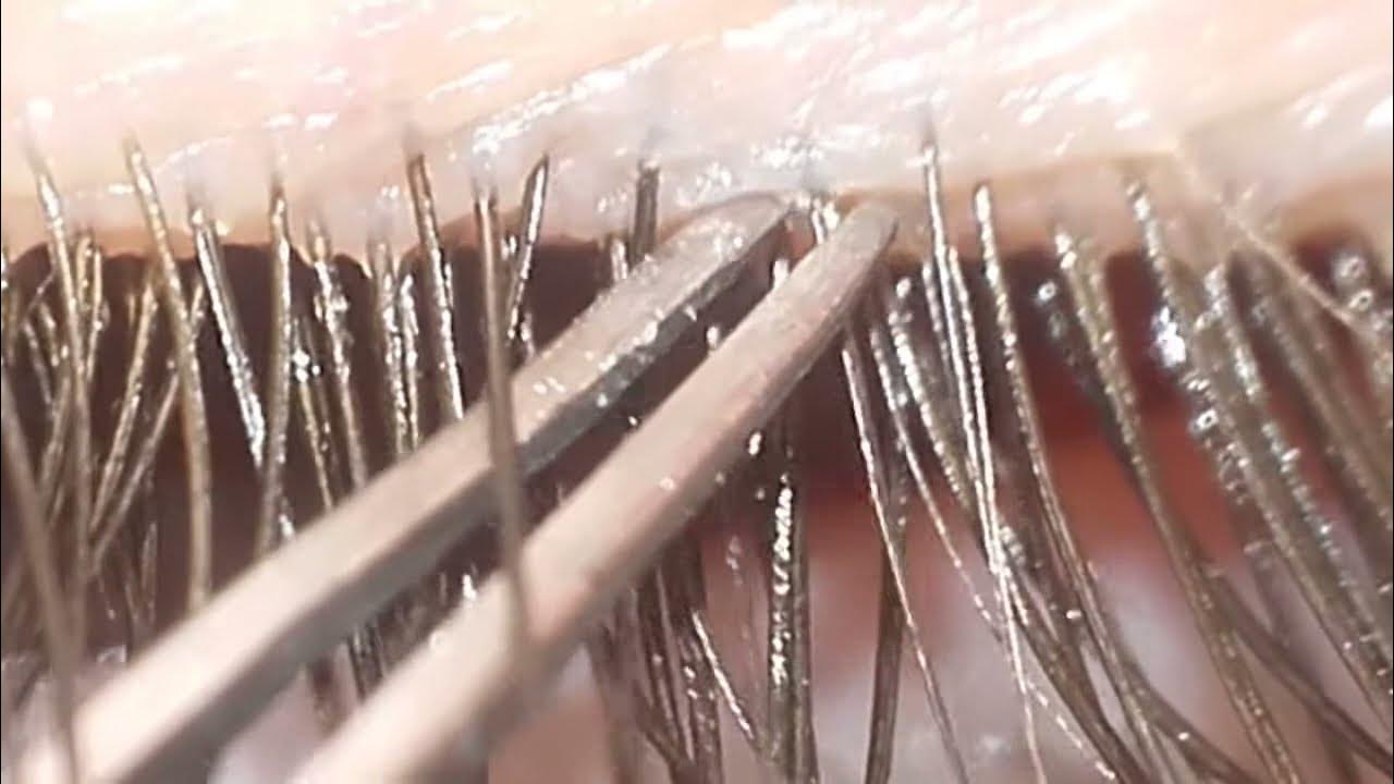 Eyelash Mites (Demodex) YouTube