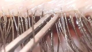 Eyelash Mites (Demodex)