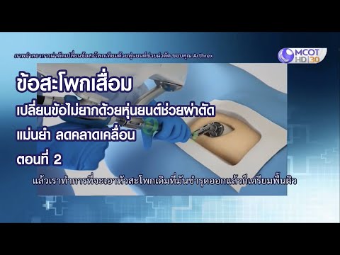 รพ ธนบุรีหุ่นยนต์ช่วยผ่าตัด ข้อสะโพก 2 #อุ่นใจใกล้หมอ #โรงพยาบาลธนบุรี #หุ่นยนต์ช่วยผ่าตัด