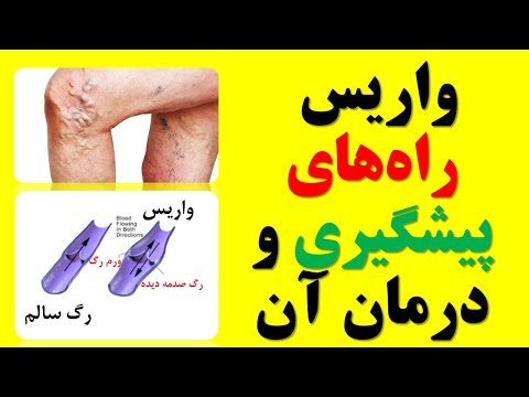 واریس و راههای پیشگیری و درمان آن