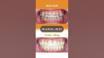 Hành trình LỘT XÁC nhờ niềng răng của Bảo Nhi