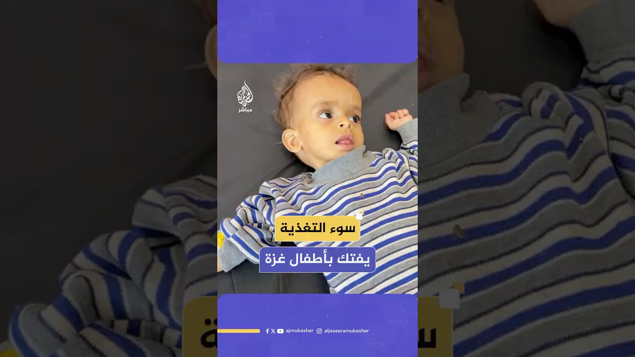 طبيب فلسطيني يكشف عن أعراض غريبة لأطفال غزة بسبب سوء التغذية