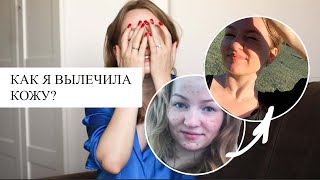 КАК Я ВЫЛЕЧИЛА АКНЕ? | гормоны, питание, уход