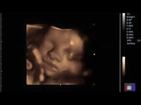 Stork Vision Ultrasound