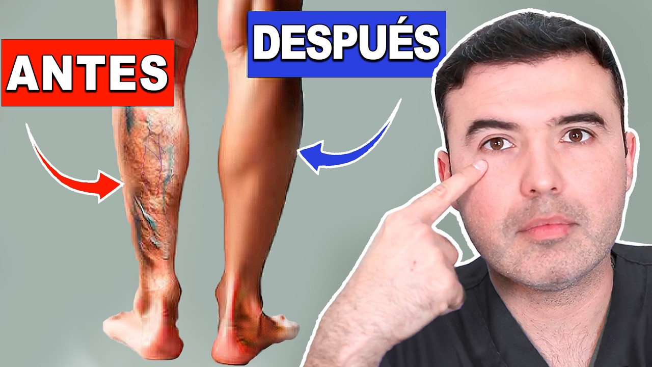 MEDICO REVELA como hace DESAPARECER las VARICES de sus pacientes