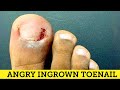 INFECTED INGROWN TOENAIL REMOVAL !!!