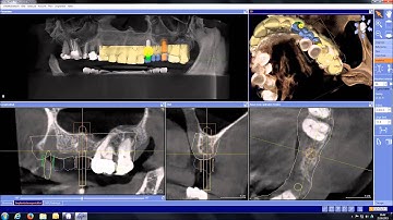 inLab SW 15 - CEREC Guide 2 Workflow with GALILEOS