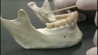 Indirect IA nerve block on a model