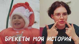 картинка: брекеты моя история | как всё началось