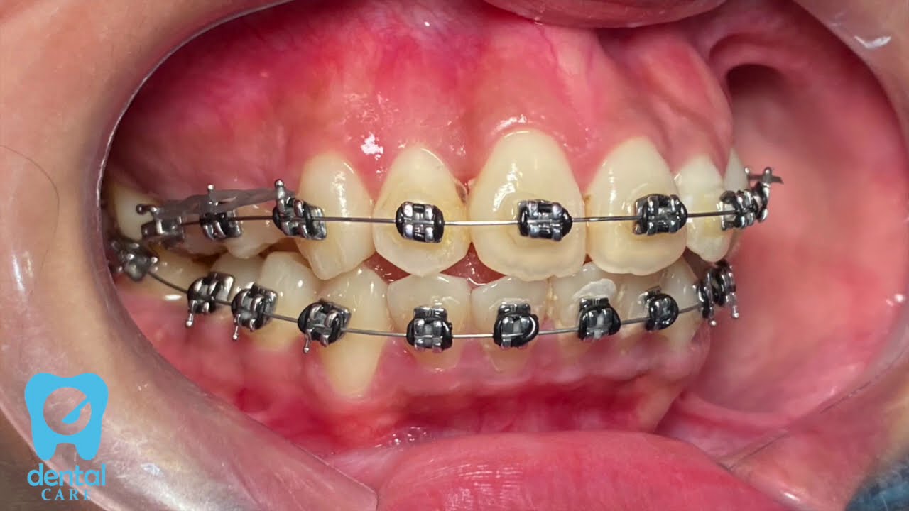 PENTING rajin kontrol behel gigi!