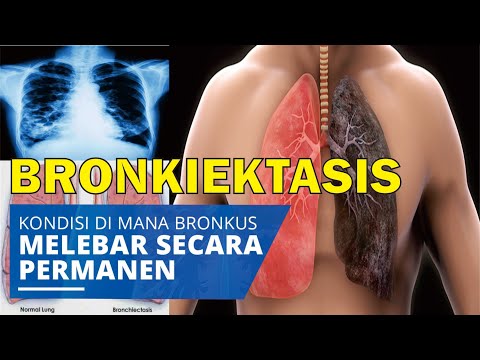 Video: Bronkiektasis: Gejala, Pengobatan, Diagnosis, Penyebab