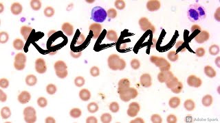 Rouleaux Formation: Erythrocytes on Peripheral Blood Smear in Multiple Myeloma (Hemepath Hematology)