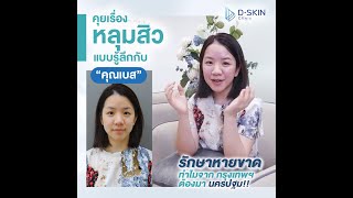 รีวิว รักษาหลุมสิว หายขาด! หน้าเนียน เหมือนกันไม่เคยเป็นสิวมาก่อน! II รีวิวจากคุณเบส