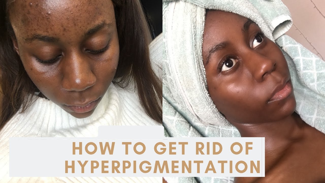 How To Get Rid Of Hyperpigmentation Quickly In 4 Months Youtube