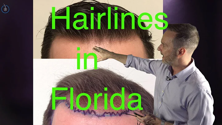 Hairline Hair Transplants in Florida - Dr. Nusbaum...