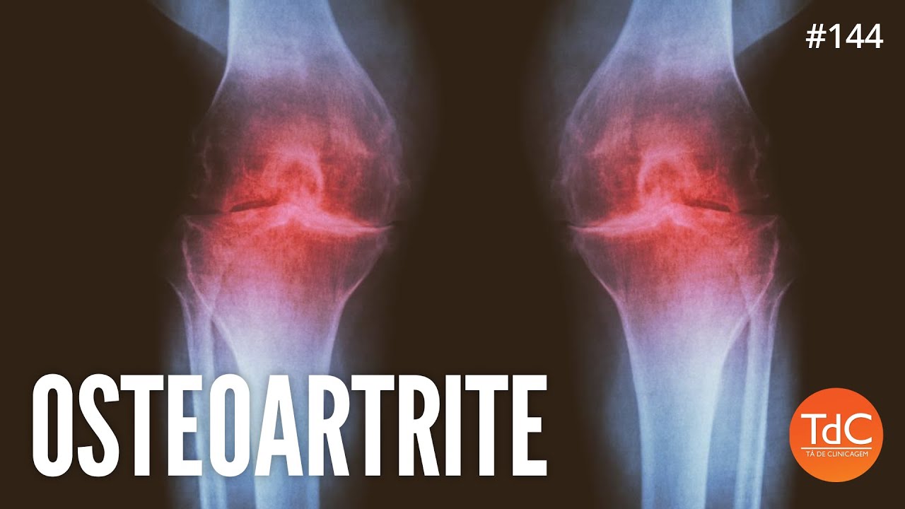 Thumbnail - Osteoartrite - Episódio 144