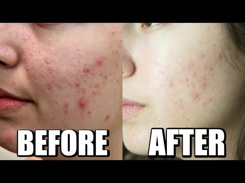 ACNE CHEMICAL PEEL BEFORE AND AFTER,  TREATMENT JOURNEY TO CLEAR SKIN