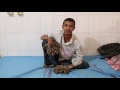 'Tree man’ Abul Bajandar set for life-changing surgery in Bangladesh