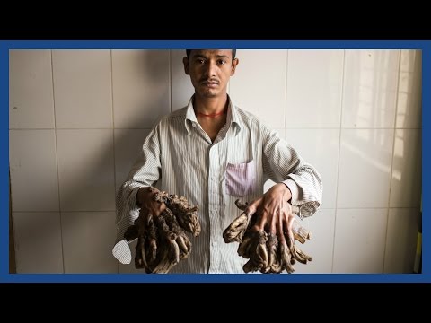 &rsquo;Tree man’ Abul Bajandar set for life-changing surgery in Bangladesh