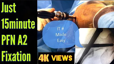 Proximal Femoral Nailing(PFN A2) Step By Step | Free Hand Distal Femoral Locking Surgical Technique.