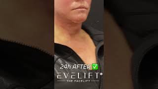 Before And 24 Hours After EVE Lift™ | Eden Plastic Surgery: Dr. Ali Charafeddine, MD