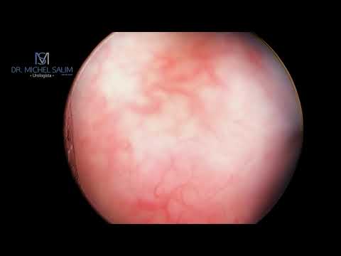 Vídeo: O que é uretrotomia óptica?