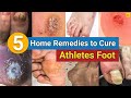 5 home remedies to cure your athletes foot permanently  credihealth infection homeremedies