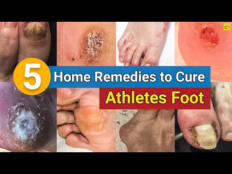 वीडियो: त्वचा की सूजन को ठीक करने के 3 तरीके