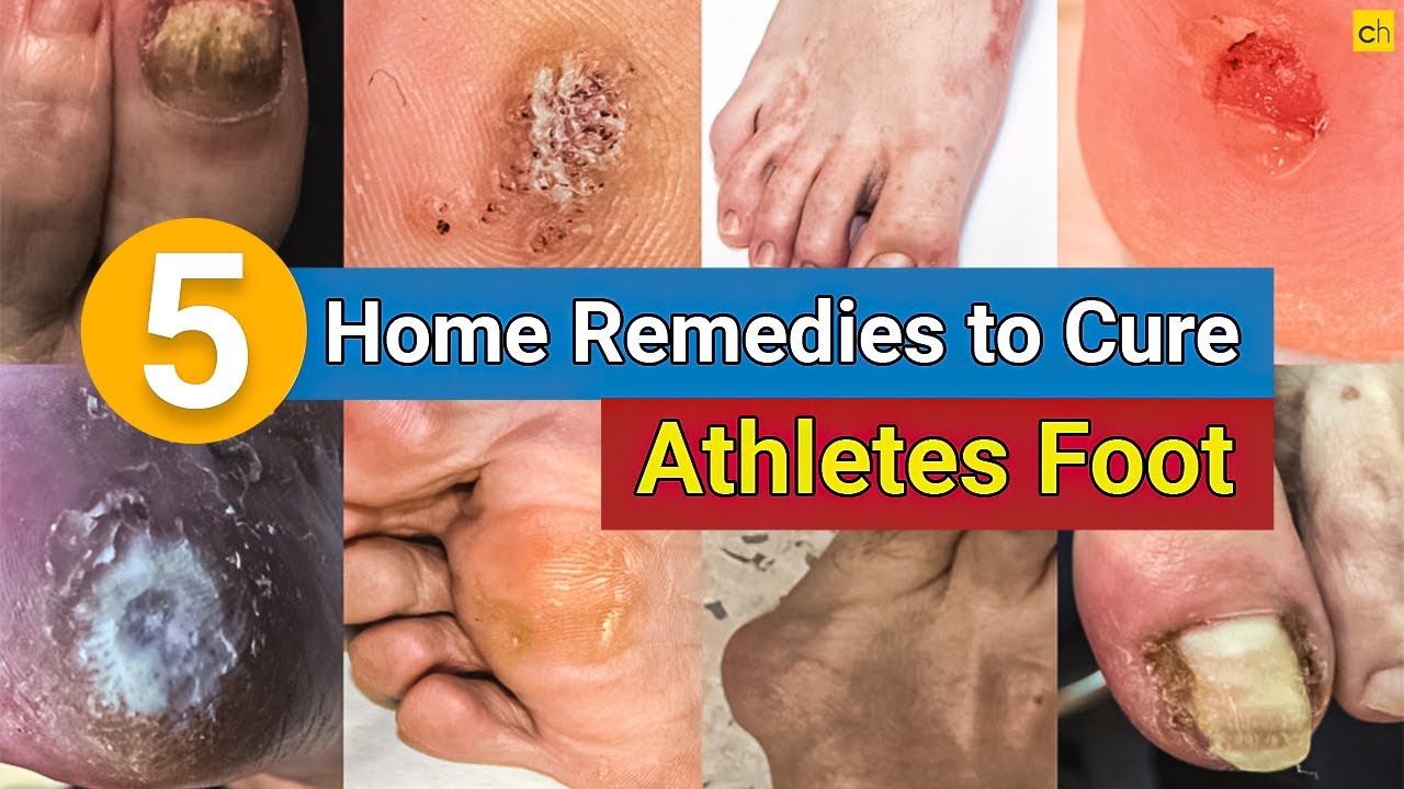 Homeopathic Remedy for Toenail Fungus and Athlete's Foot | Cristina  Villacorta