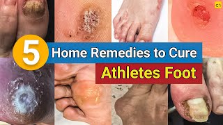 5 Home Remedies to Cure Your Athlete's Foot Permanently! | Credihealth #infection #homeremedies