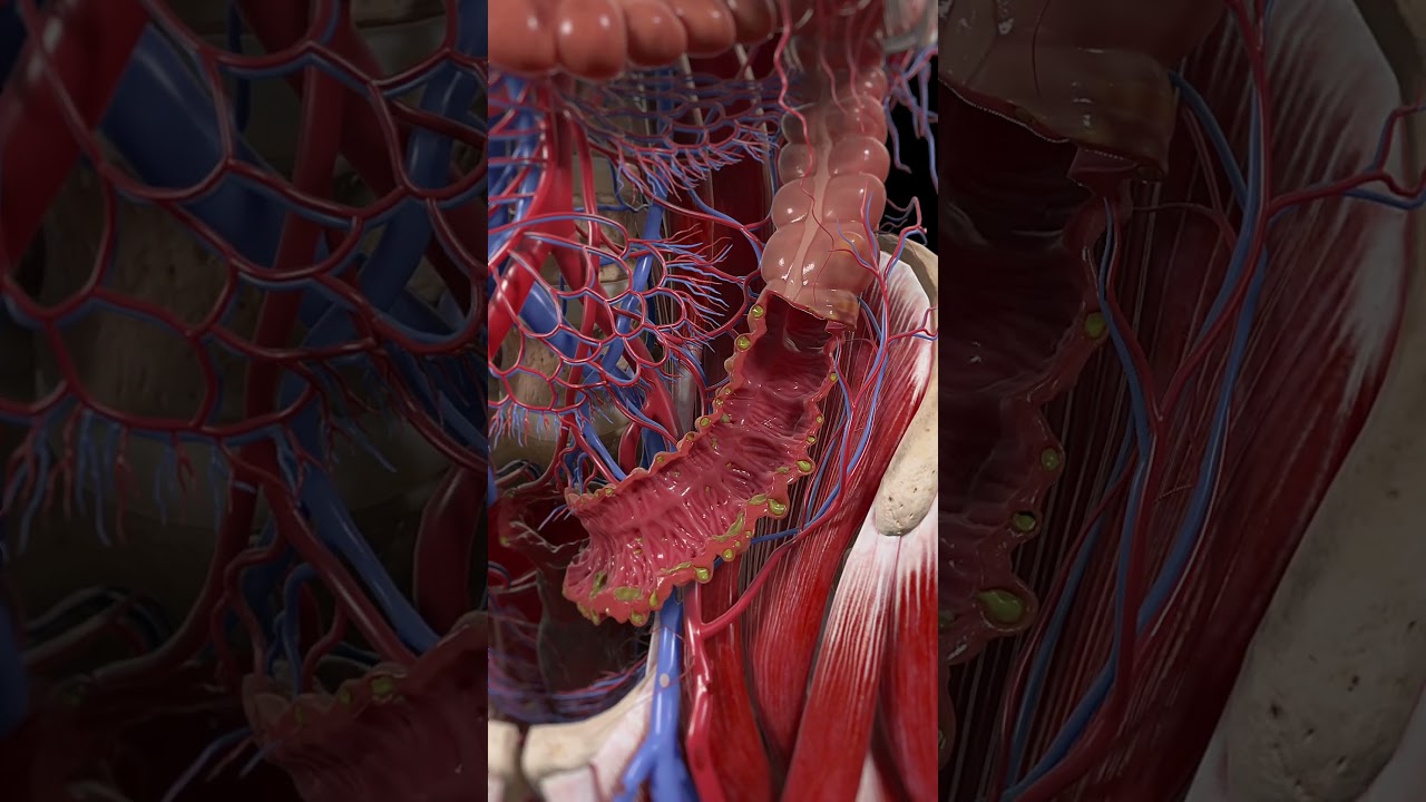 Diverticulitis 3d animation #anatomy #3d