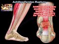 Achilles Tendon Rupture - Everything You Need To Know - Dr. Nabil Ebraheim
