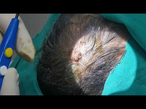 WART (scalp) - Saçlı deride siğil