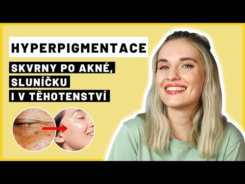 Video: 4 způsoby, jak skrýt hyperpigmentaci