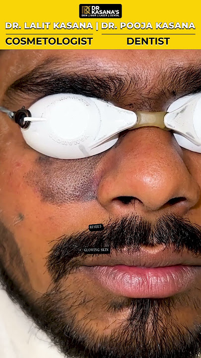 Laser Tonning Dark Spots With World's Best Q - Switch Laser at Dr. Kasana's Clinic
