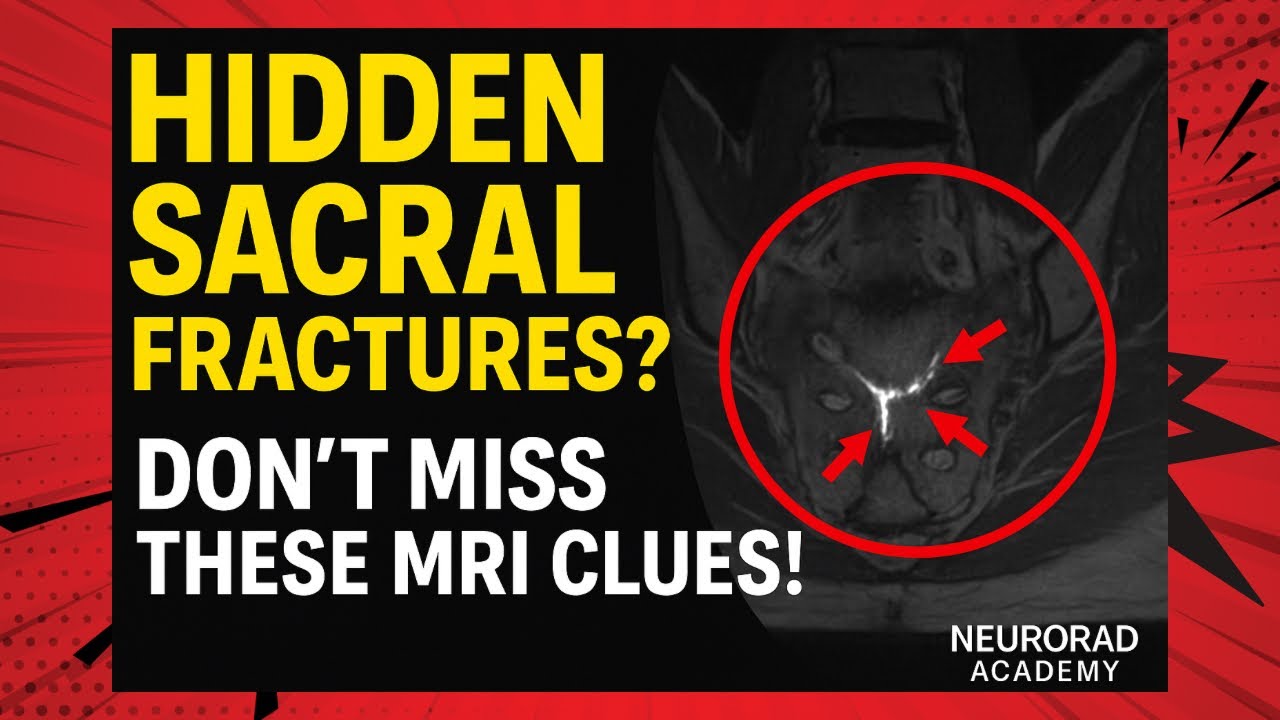 The Mysterious Fracture That Causes Chronic Back Pain: Sacral Insufficiency fracture on MRI!