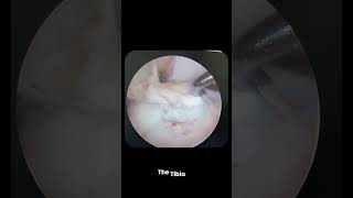 What does an ACL tear look like inside the knee? Through arthroscopy, surgeons can directly visual