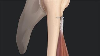 What's New Top Video: Biceps Tenotomy vs Tenodesis: Literature Review and Rationale for Tenodesis