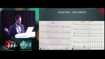 Left Bundle Pacing - IHRS by Dr Shunmuga Sundaram P
