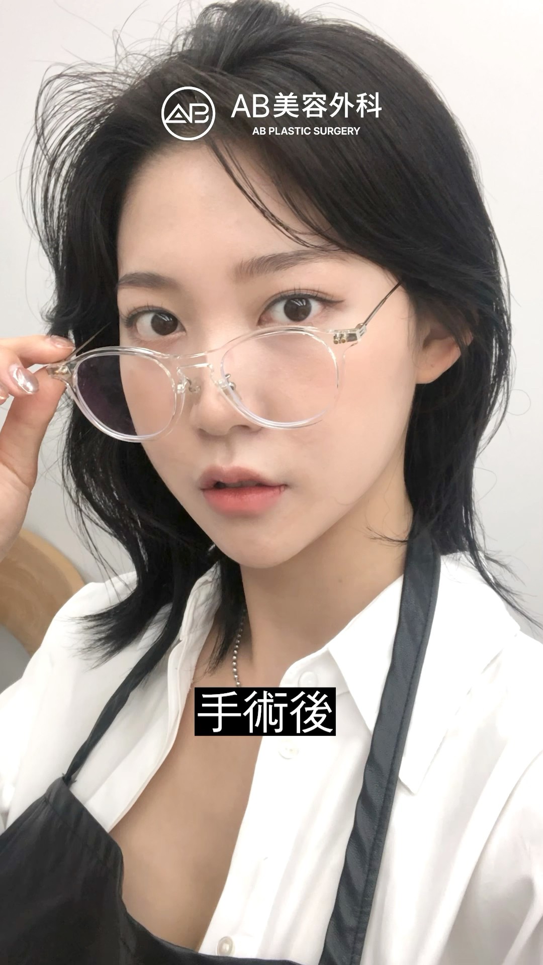 輪郭3点整形のビフォーアフター！ | AB美容整形