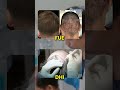 How I Got a Perfect Hair Transplant in India for Half the Price
