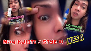 Kuliti Or Stye Paano Gamutin? Ano Ang Gamot Sa Kuliti? Ano Ng Kuliti?