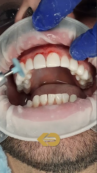 How we do COMPOSITE BONDING