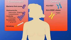 The Role of Environment and Genetics in the Development of Undifferentiated Arthritis