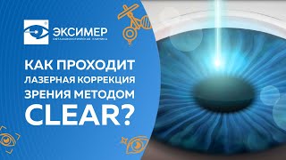 Лазерная коррекция зрения методом CLEAR. Офтальмологическая клиника 