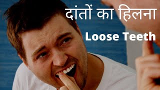 दांतों का हिलना, #Toothmobility,  #Loose Teeth Treatment & #Symptom दांतों के हिलने की दवा screenshot 5