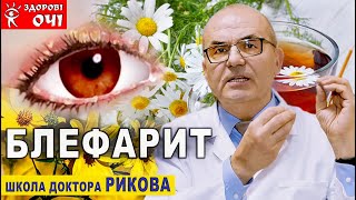 БЛЕФАРИТ – проф. С.О.Риков. БЛЕФАРИТ ЛІКУВАННЯ НАРОДНИМИ МЕТОДАМИ. Школа доктора Рикова/С.Риков vlog